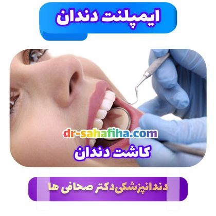 ایمپلنت دندان دکتر صحافی ها دندانپزشک شمال تهران