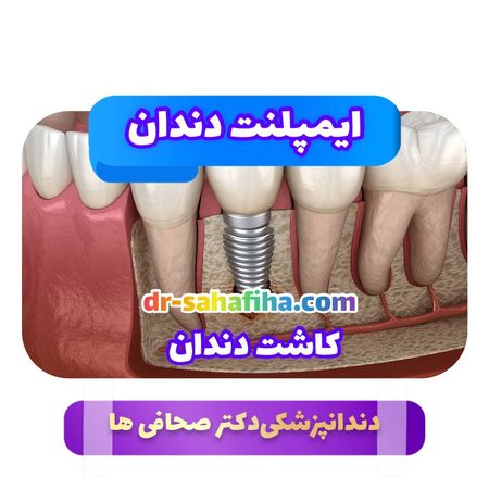 کاشت دندان دکتر صحافی ها